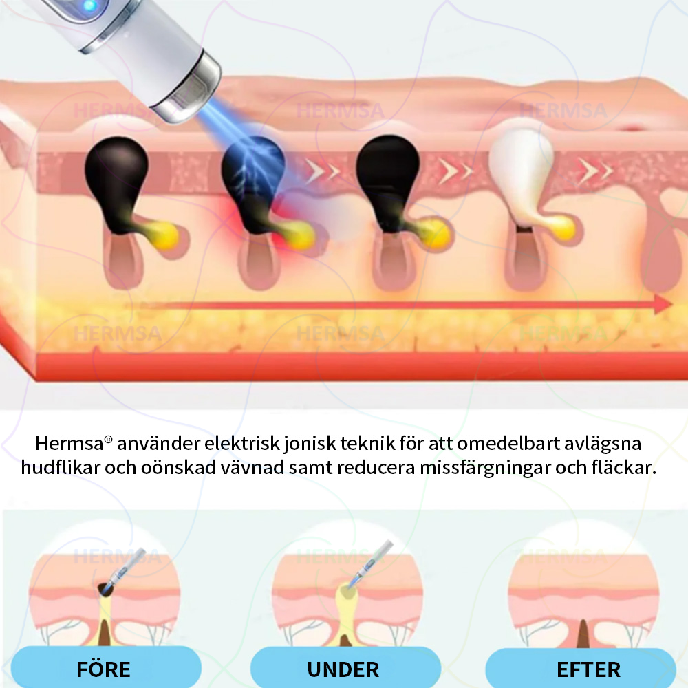 Hermsa® icke-invasiv laserpenna - för borttagning av födelsemärken och vårtor (🔥 Sista dagen - 80% REA)