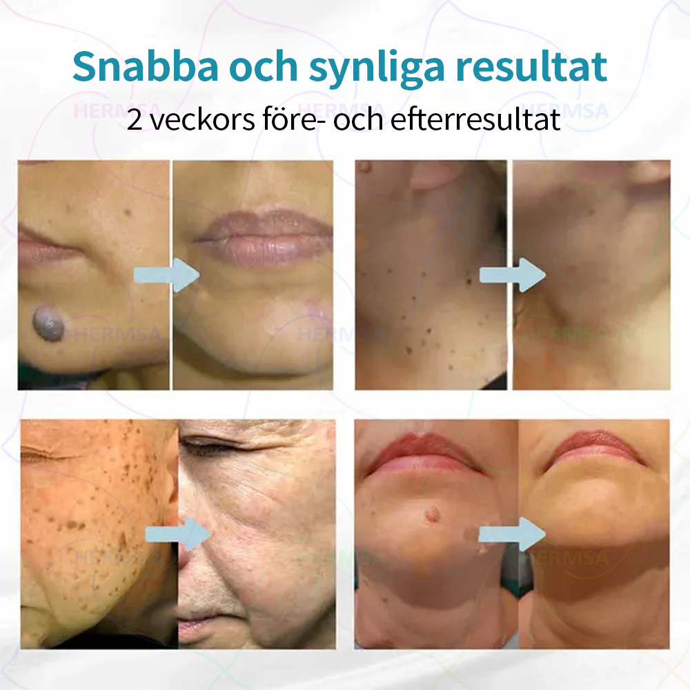 Hermsa® icke-invasiv laserpenna - för borttagning av födelsemärken och vårtor (🔥 Sista dagen - 80% REA)