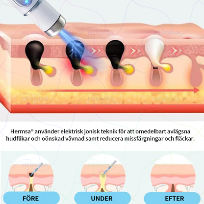Hermsa® icke-invasiv laserpenna - för borttagning av födelsemärken och vårtor (🔥 Sista dagen - 80% REA)