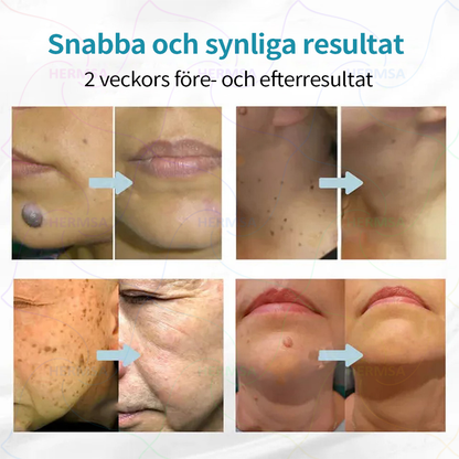 Hermsa® icke-invasiv laserpenna - för borttagning av födelsemärken och vårtor (🔥 Sista dagen - 80% REA)